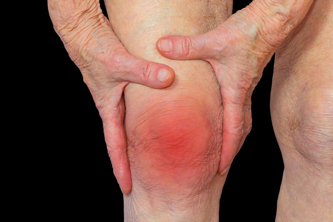 Sandy sensation in eyes common in patients with Rheumatoid Arthritis