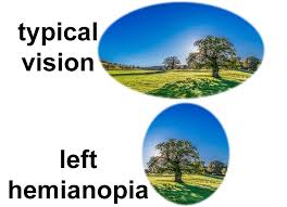 Study will test the effectiveness of retraining vision after stroke