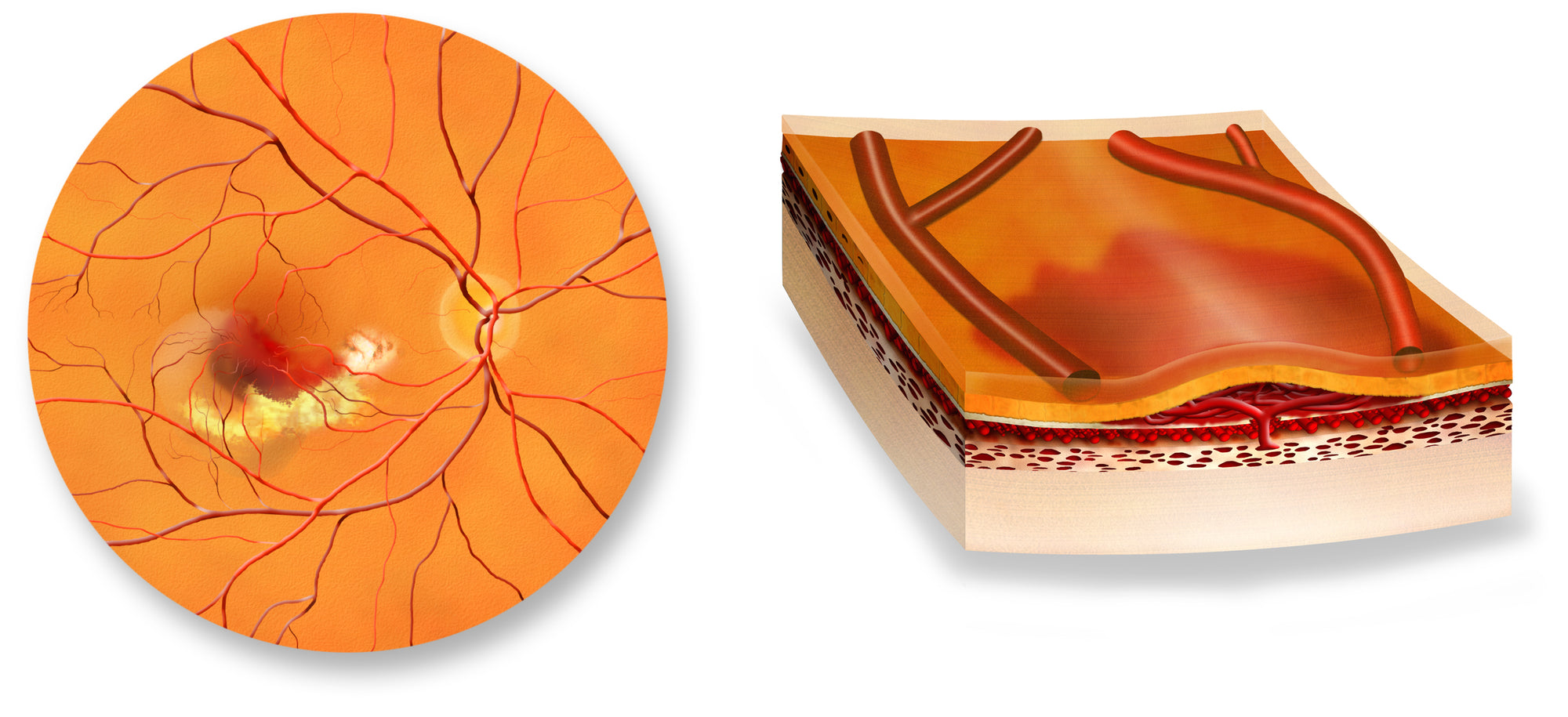 Wet Macular Degeneration