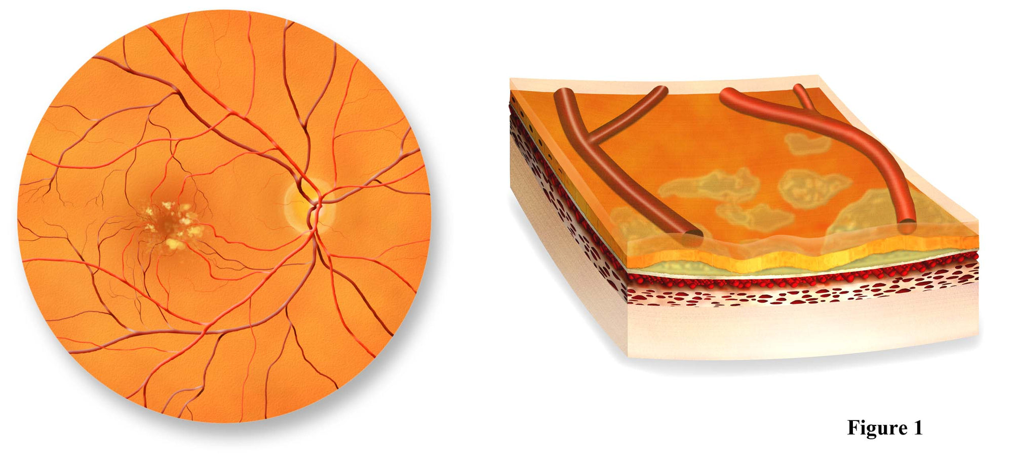 Detecting Early Macular Degeneration
