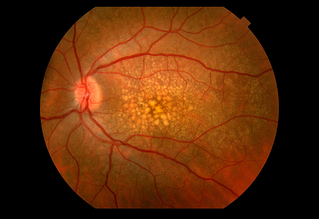 Who Should Not Take AREDS 2: Understanding the Risks and Considerations