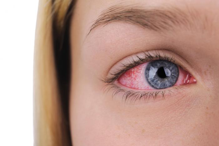 Dry Eye Condition