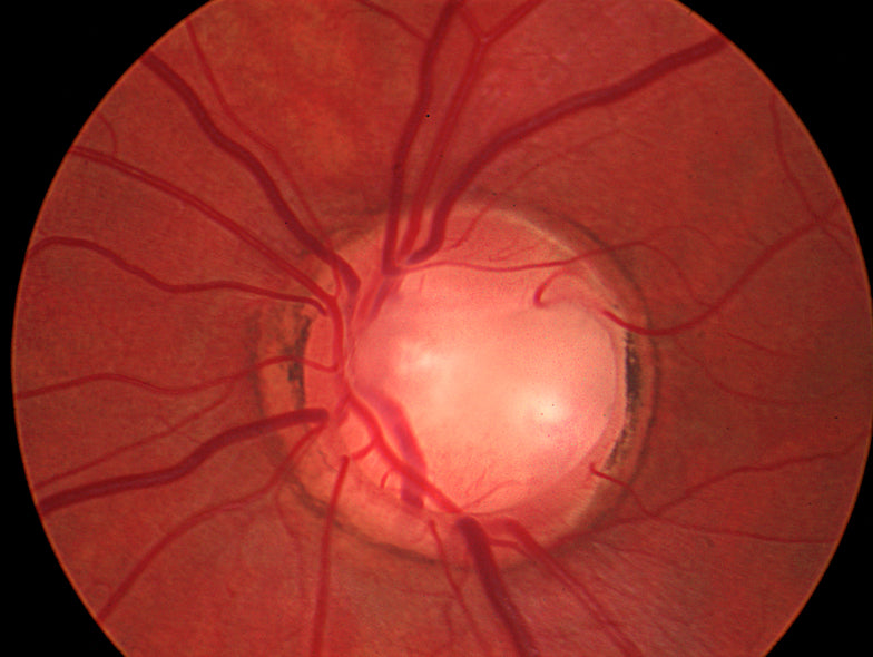 What is Glaucoma?