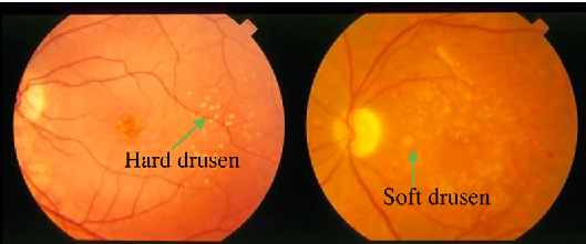 Macular Degeneration | Hard versus Soft Drusen