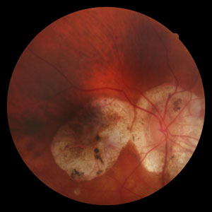 Myopic Macular Degeneration