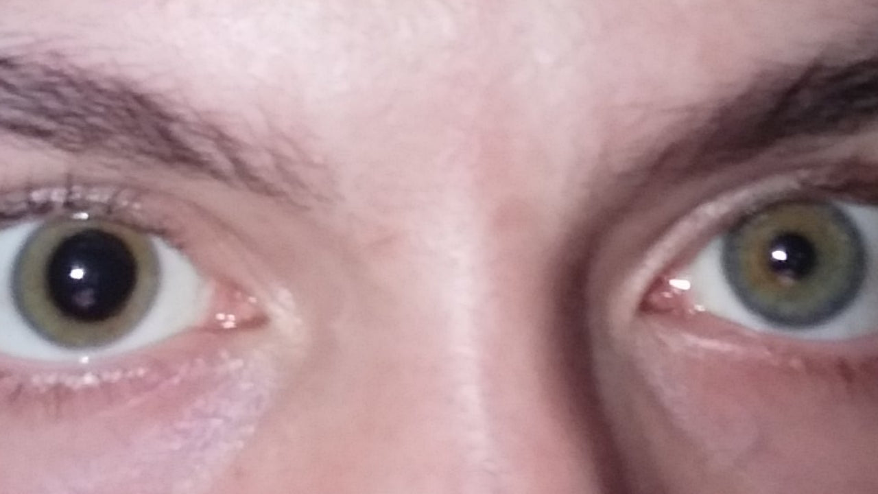 anisocoria means the pupils are of unequal size