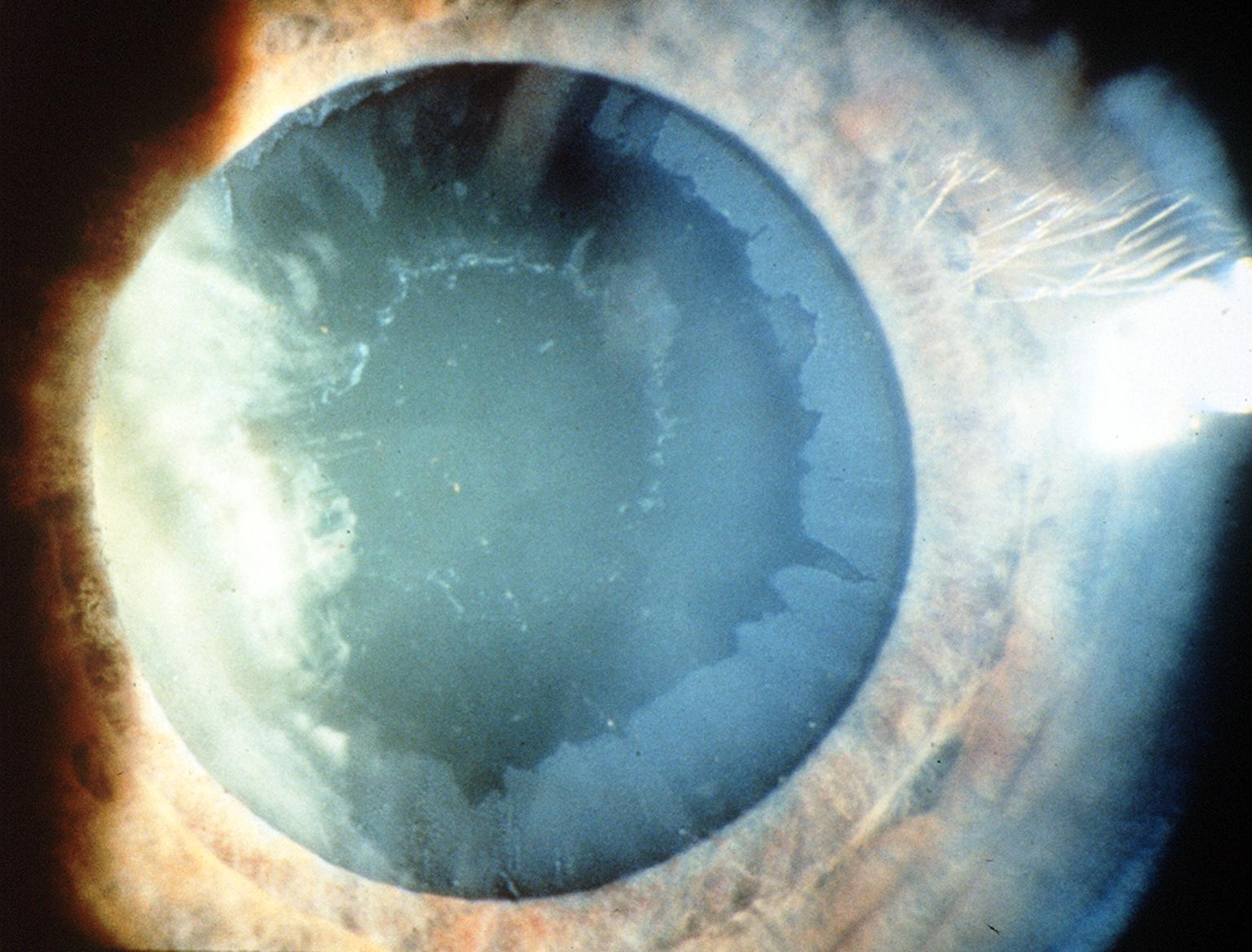 Pseudoexfoliation Syndrome