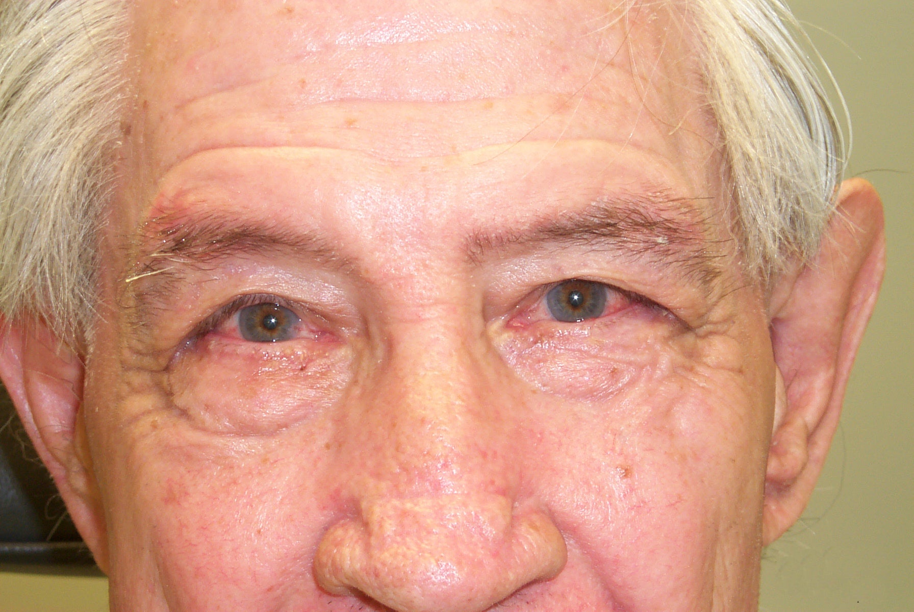 Ocular Rosacea and Dry Eye Symptoms