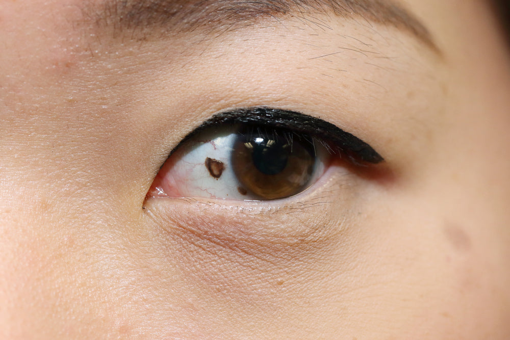 What that brown spot on your eye can mean