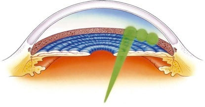Glaucoma Treatment