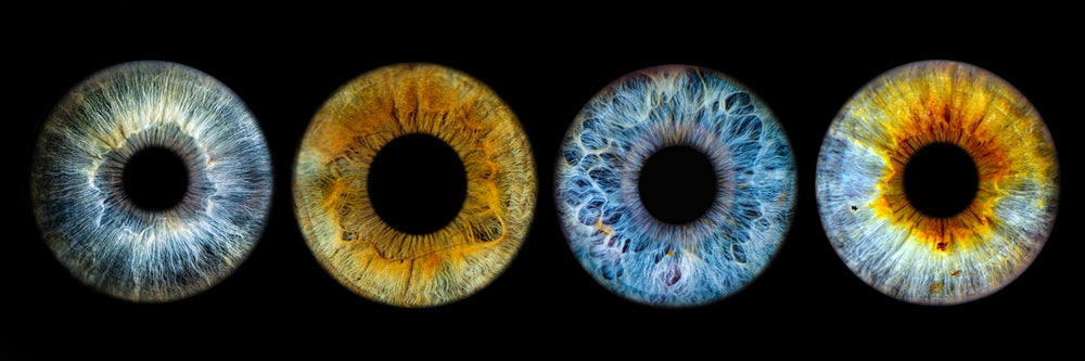 Iris freckles may be a biomarker for age-related macular degeneration